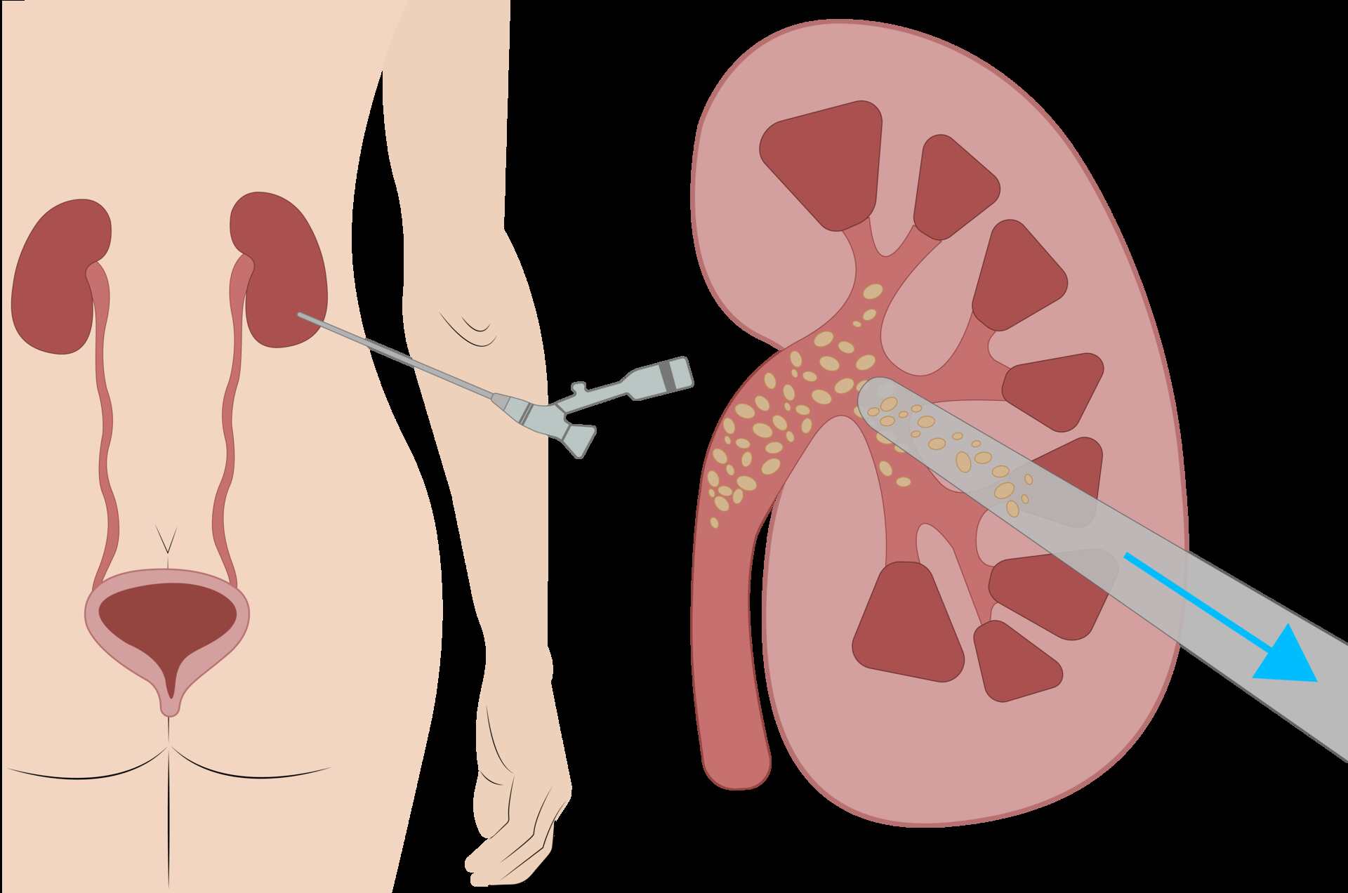 Ilustração do acesso da nefrolitotripsia percutânea e introdução do aparelho para fragmentação e remoção dos cálculos