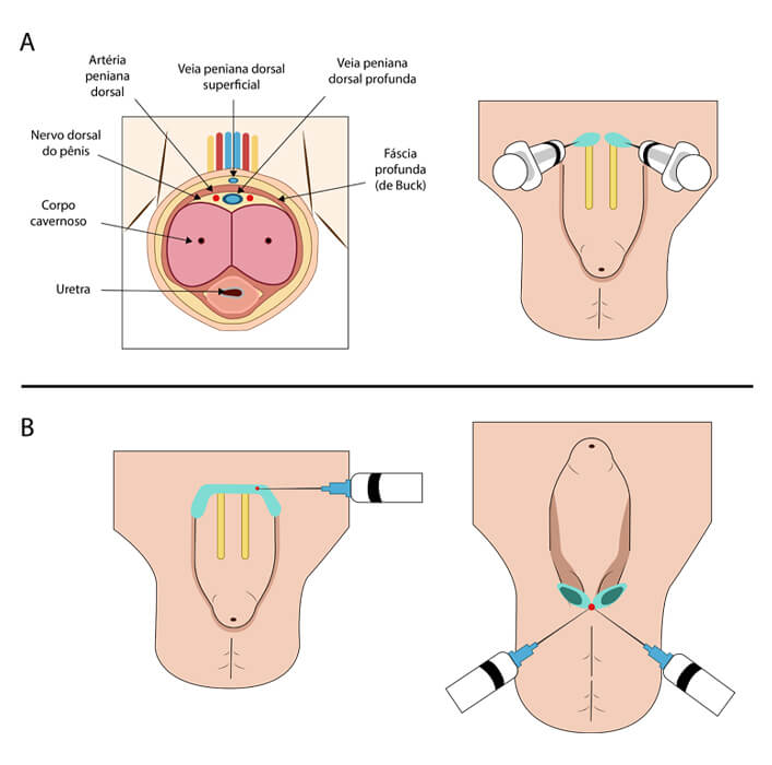 Anestesia local peniana