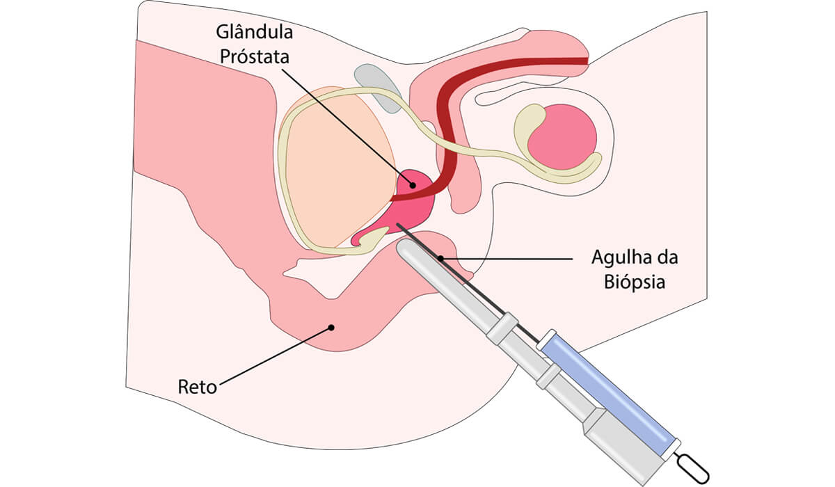 Nódulo Renal