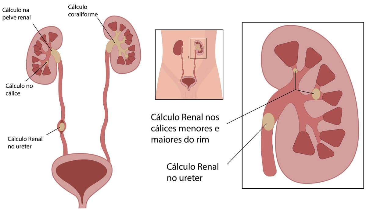Ilustração de cálculos no rim e ao longo do ureter