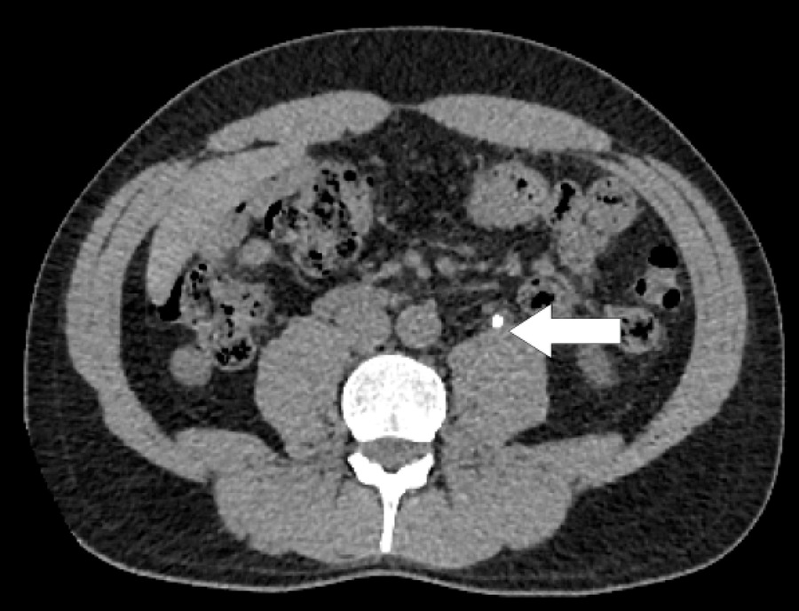 Cálculo no ureter proximal diagnosticado por tomografia