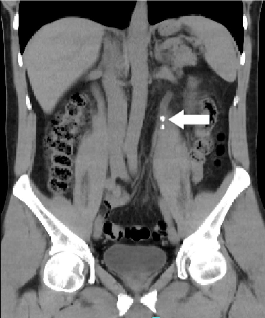 Cálculo no ureter proximal diagnosticado por tomografia