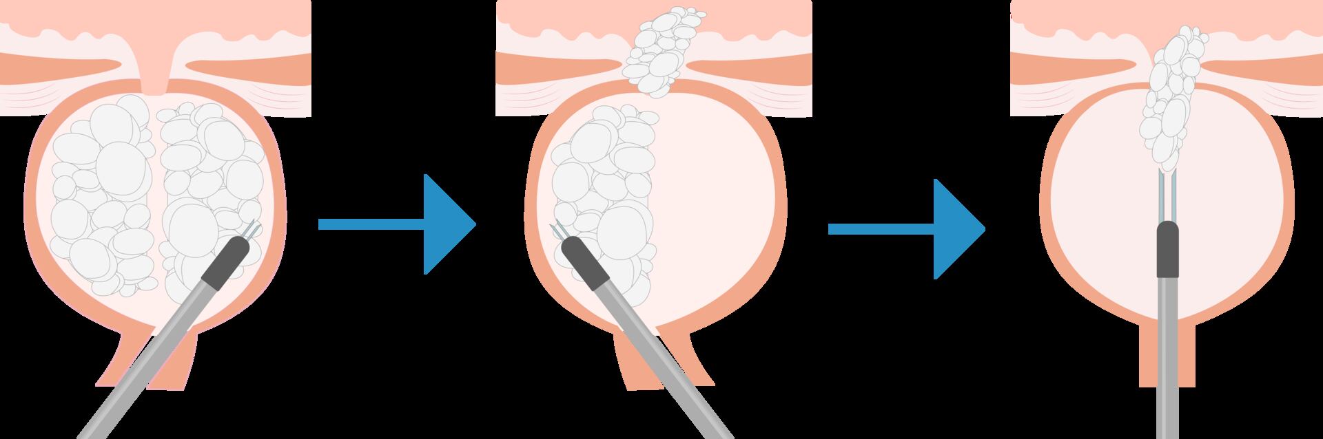 Cirurgia HoLEP