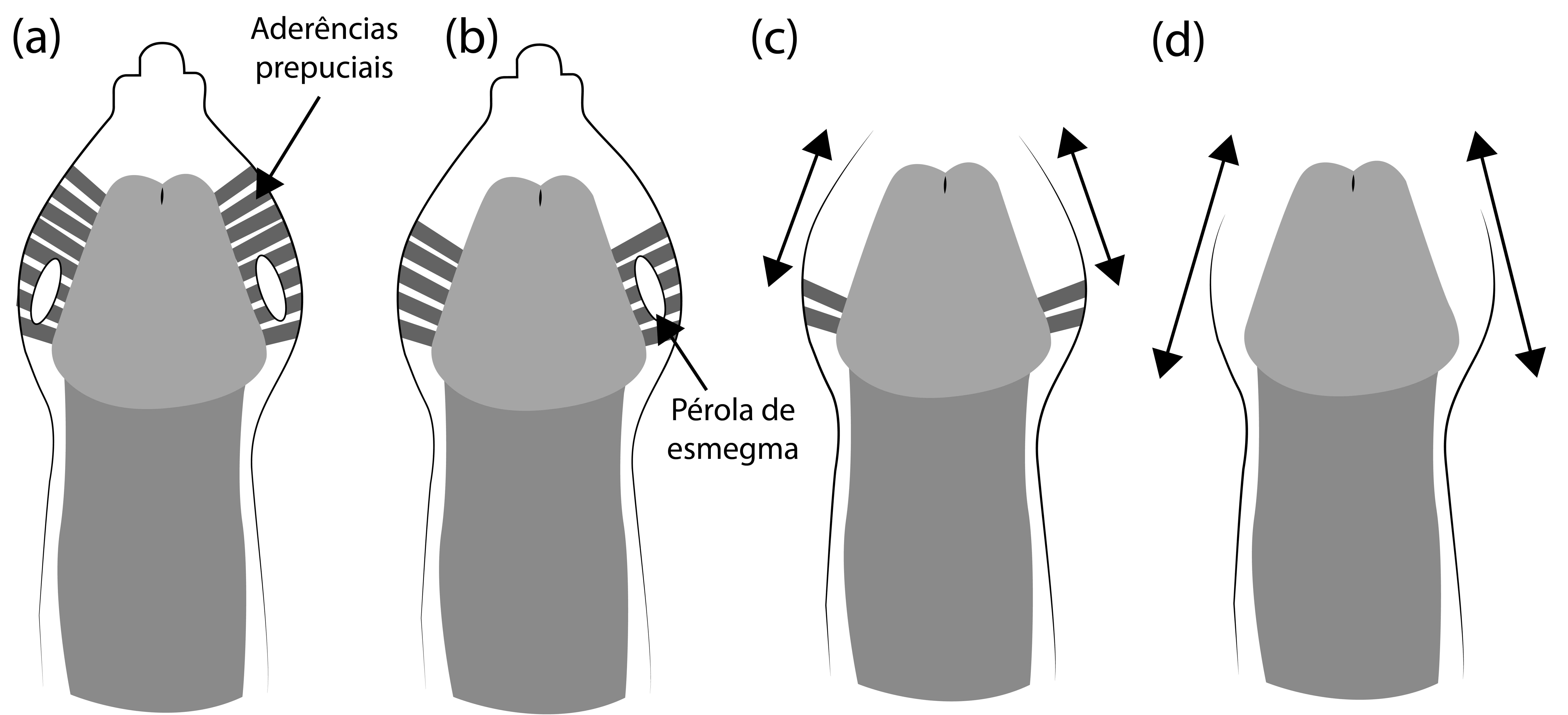 Desenvolvimento do prepúcio e sua liberação da glande