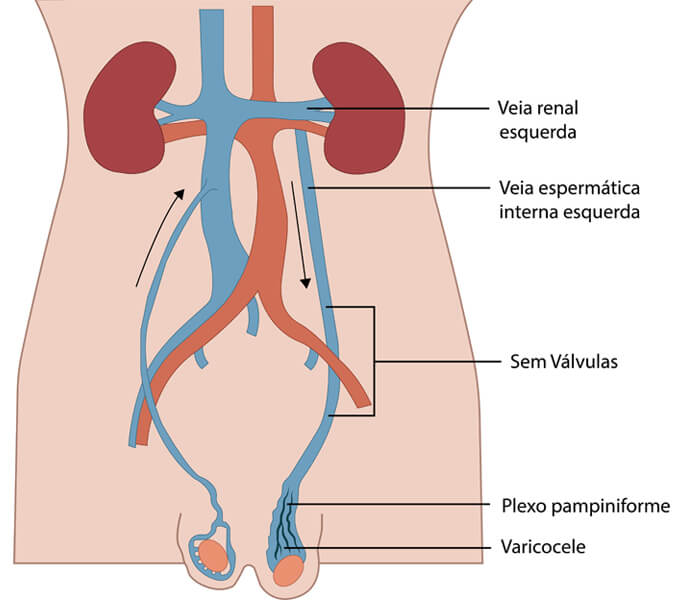 Ilustração de como é a drenagem do sistema venoso testicular