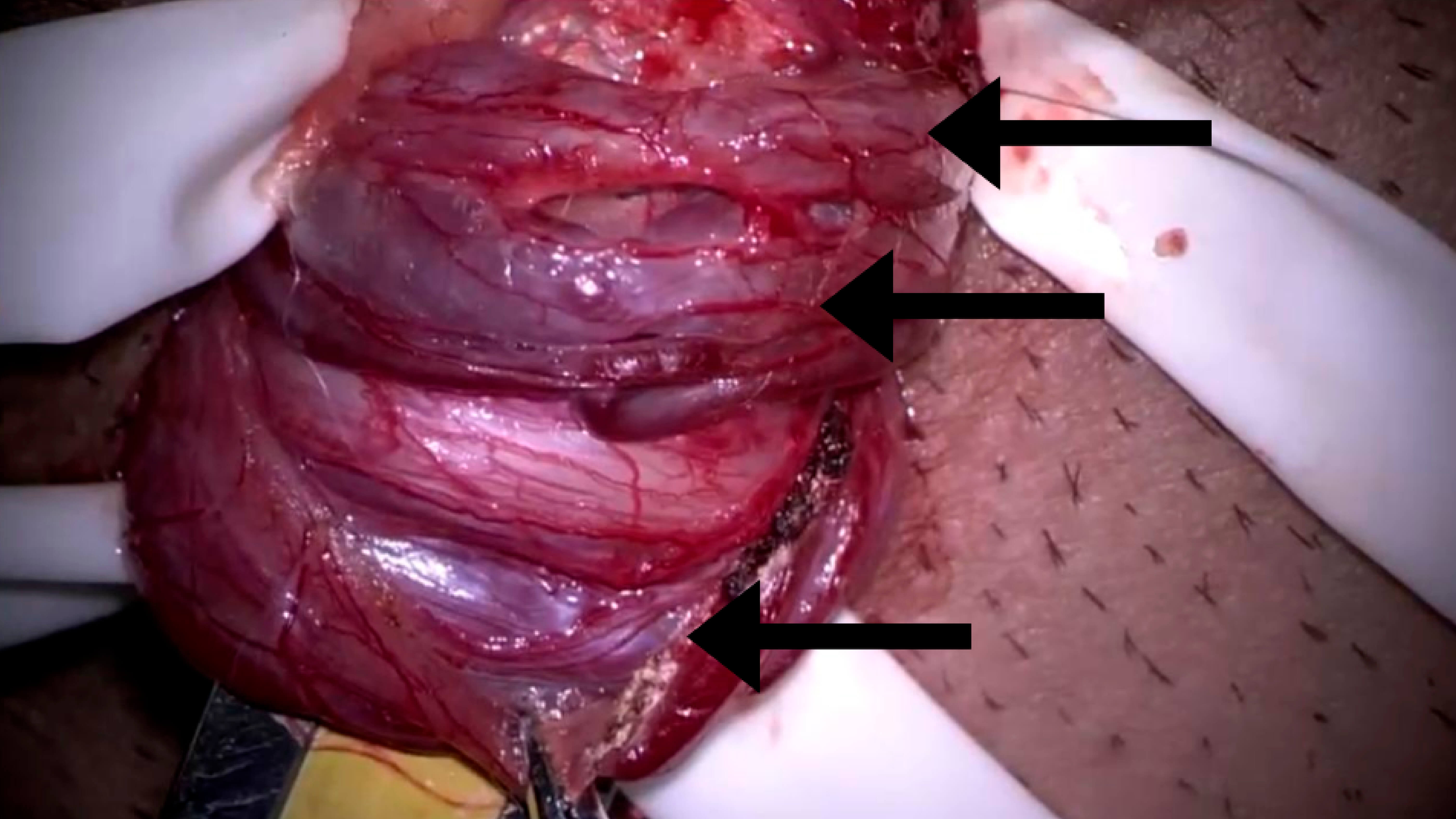 Estudo urodinâmico cordão espermático reparado com veias da varicocele (foto do intra-operatório)