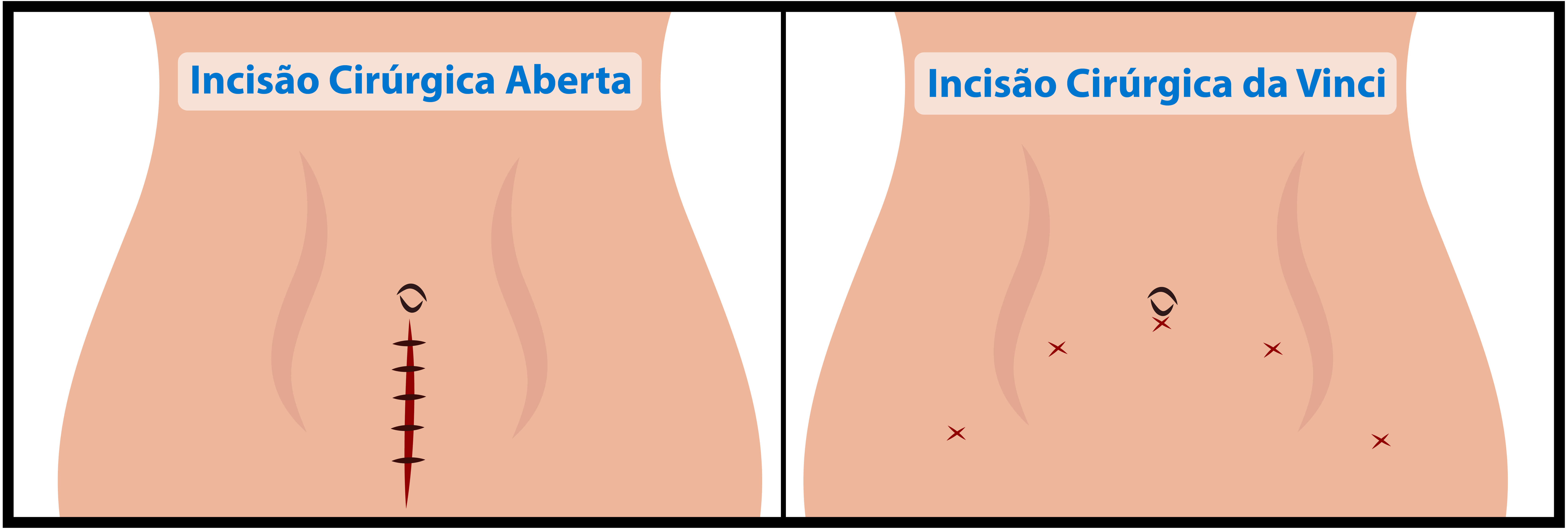 Nódulo Renal