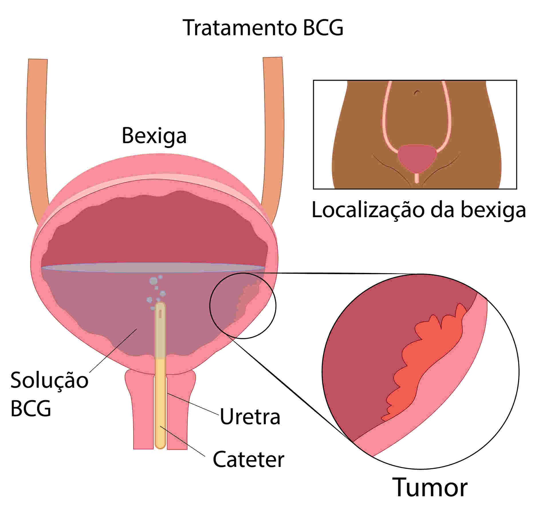 inserção do cateter e aplicação do BCG intravesical