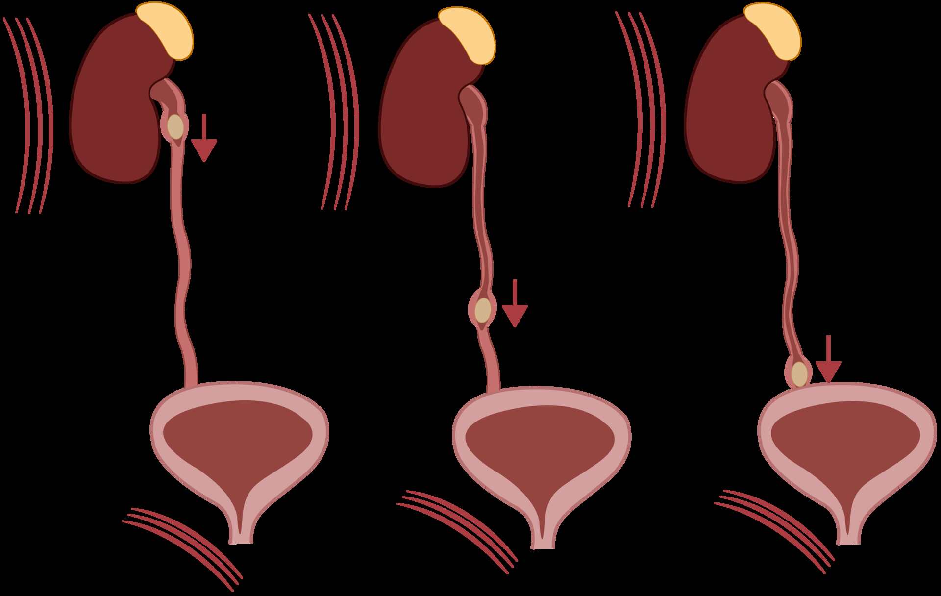 Lugares do Cálculo Renal