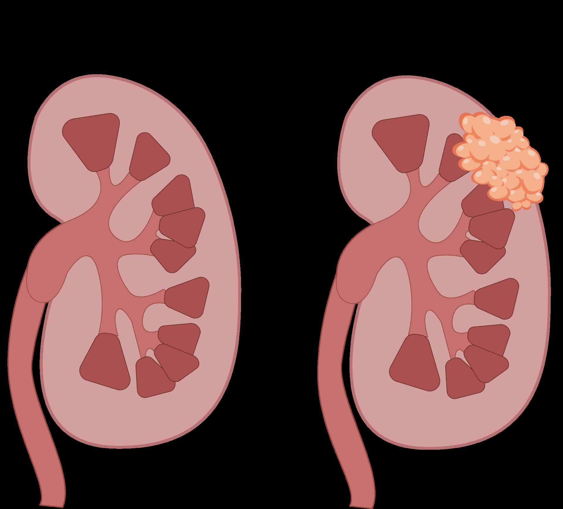 Nódulo Renal