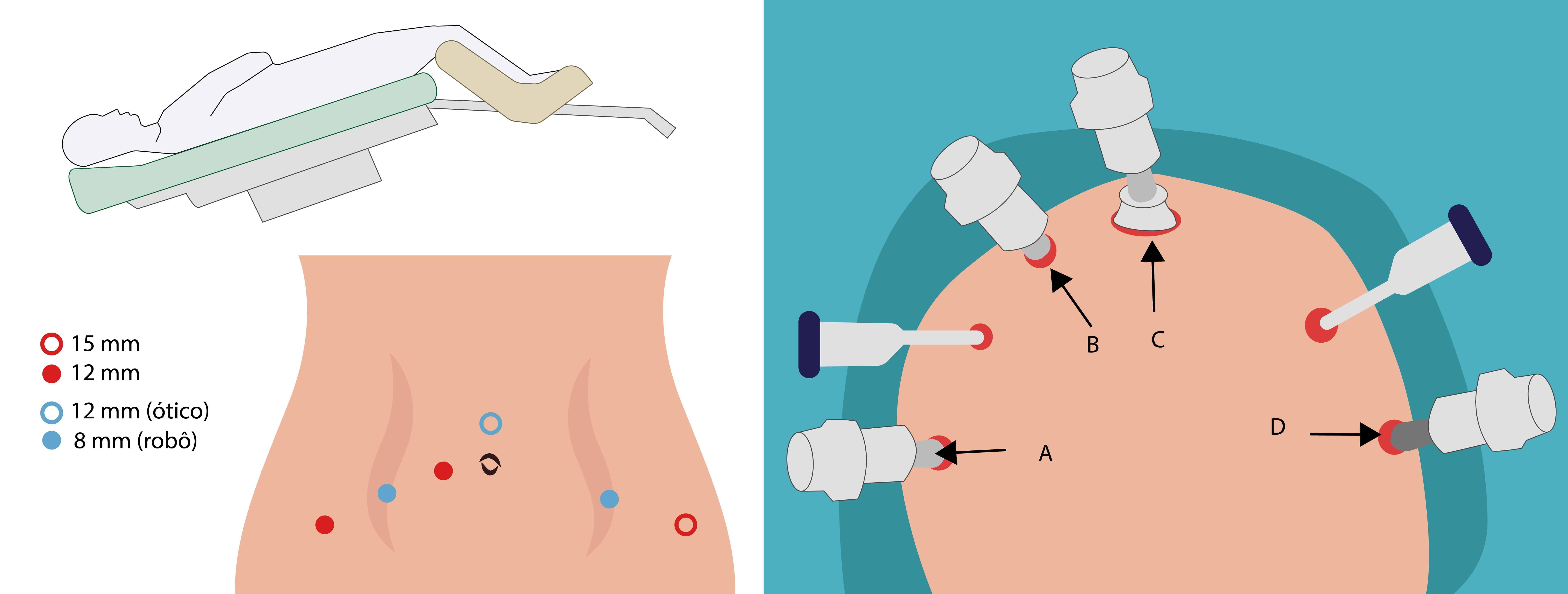 Posicionamento do paciente e dos acessos das pinças após insuflar o pneumoperitônio
