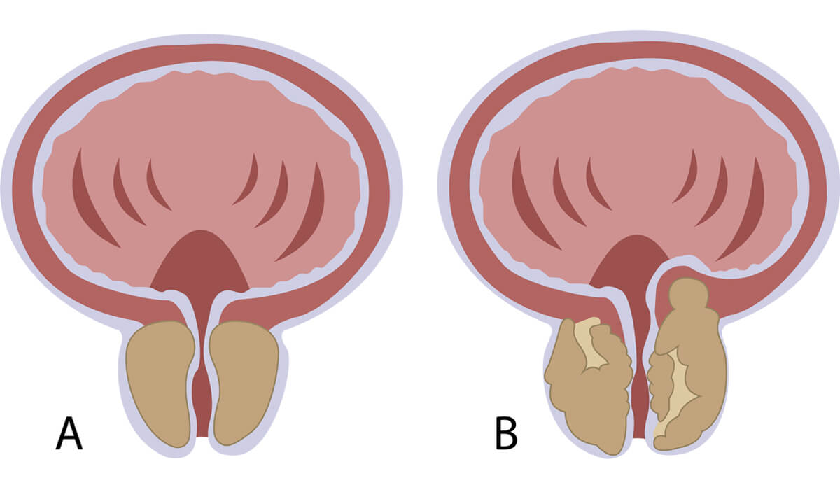 Próstata normal x Próstata com Hiperplasia Benigna