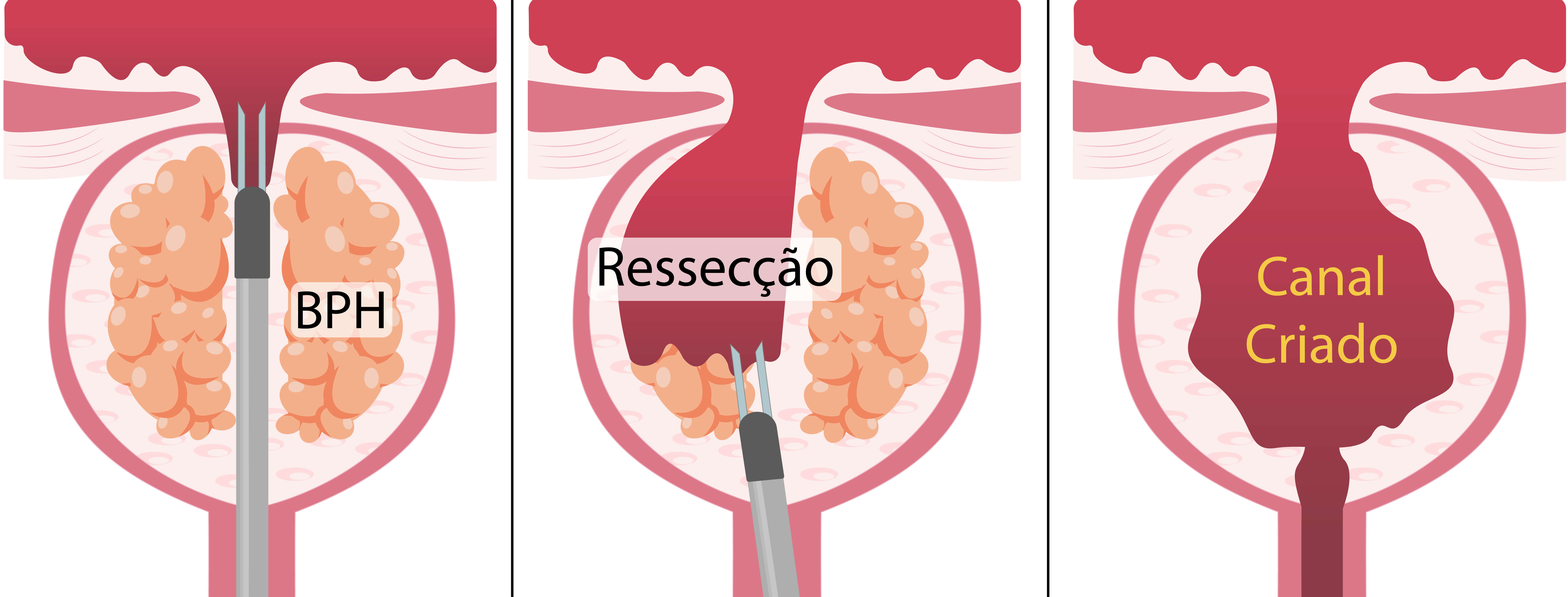 Como é feita a RTU de próstata, com abertura da porção interna da próstata