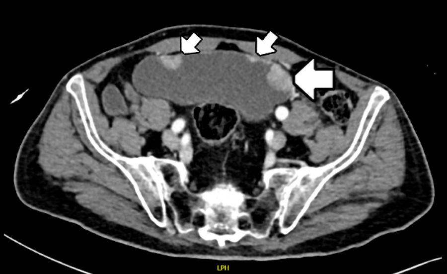 TC de abdomen com imagem na bexiga sugestiva de câncer