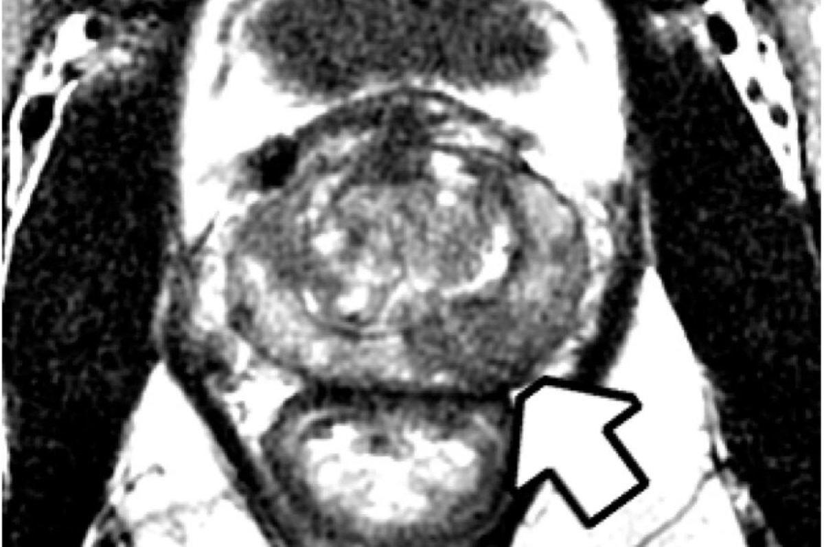 Ressonancia-magnetica-prostata
