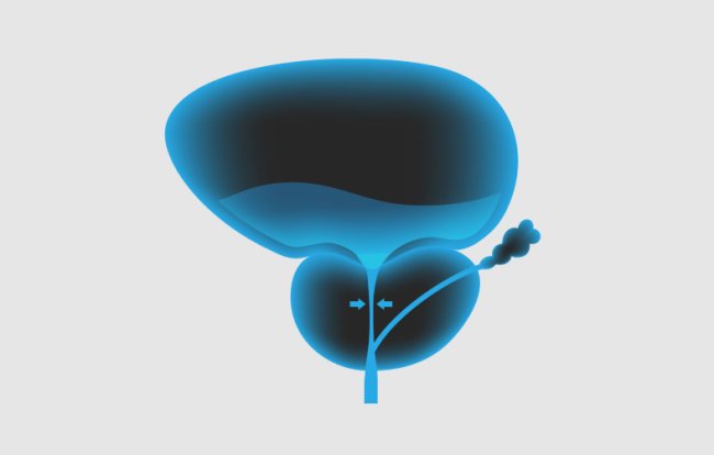 Hiperplasia Prostática