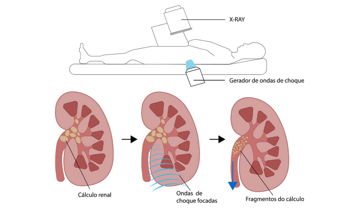 Terapia com ondas de choque extracorpórea