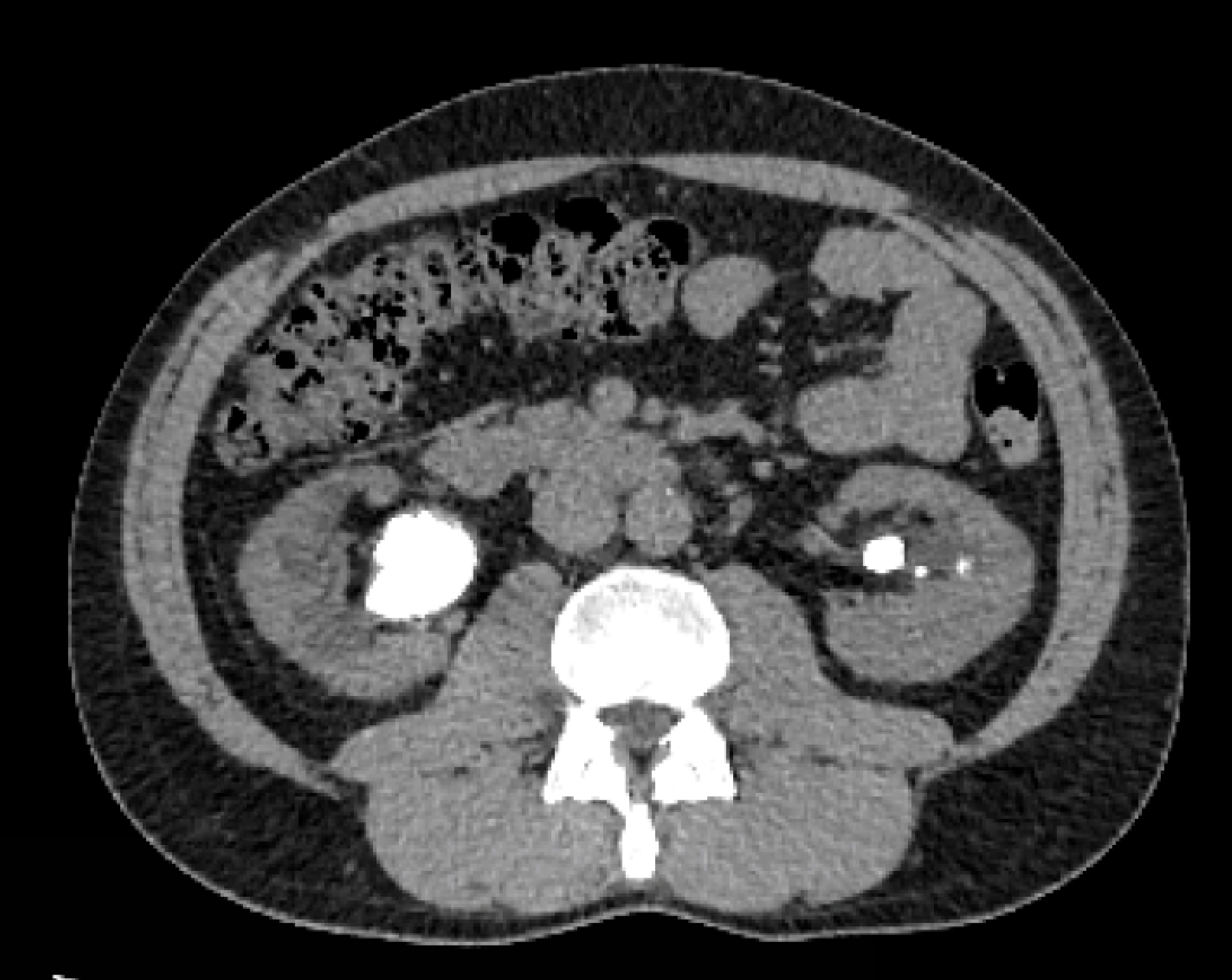 Cálculo no ureter proximal diagnosticado por tomografia