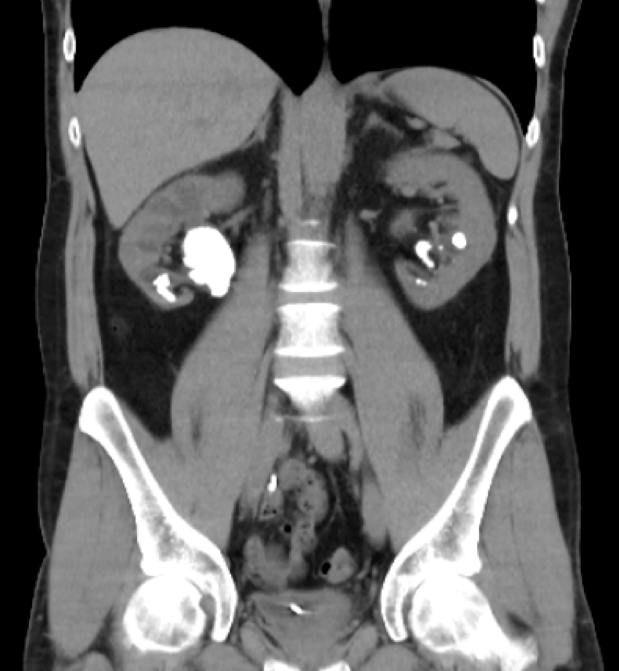Cálculo no ureter proximal diagnosticado por tomografia