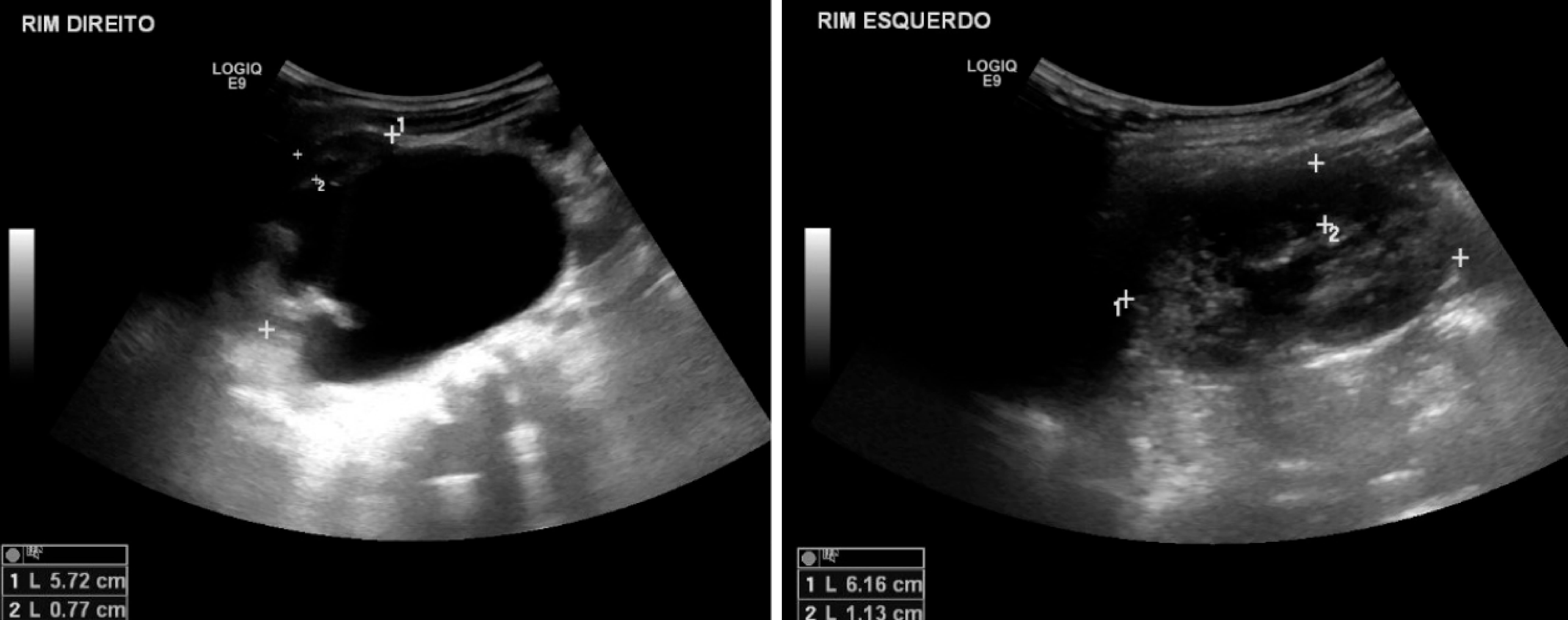 Ultrassom com e sem hidronefrose (dilatação dos rins)
