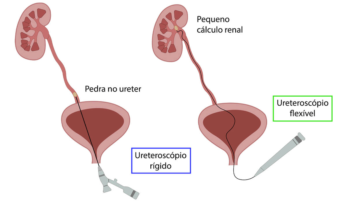 Diferença entre ureteroscopia rígida e flexível
