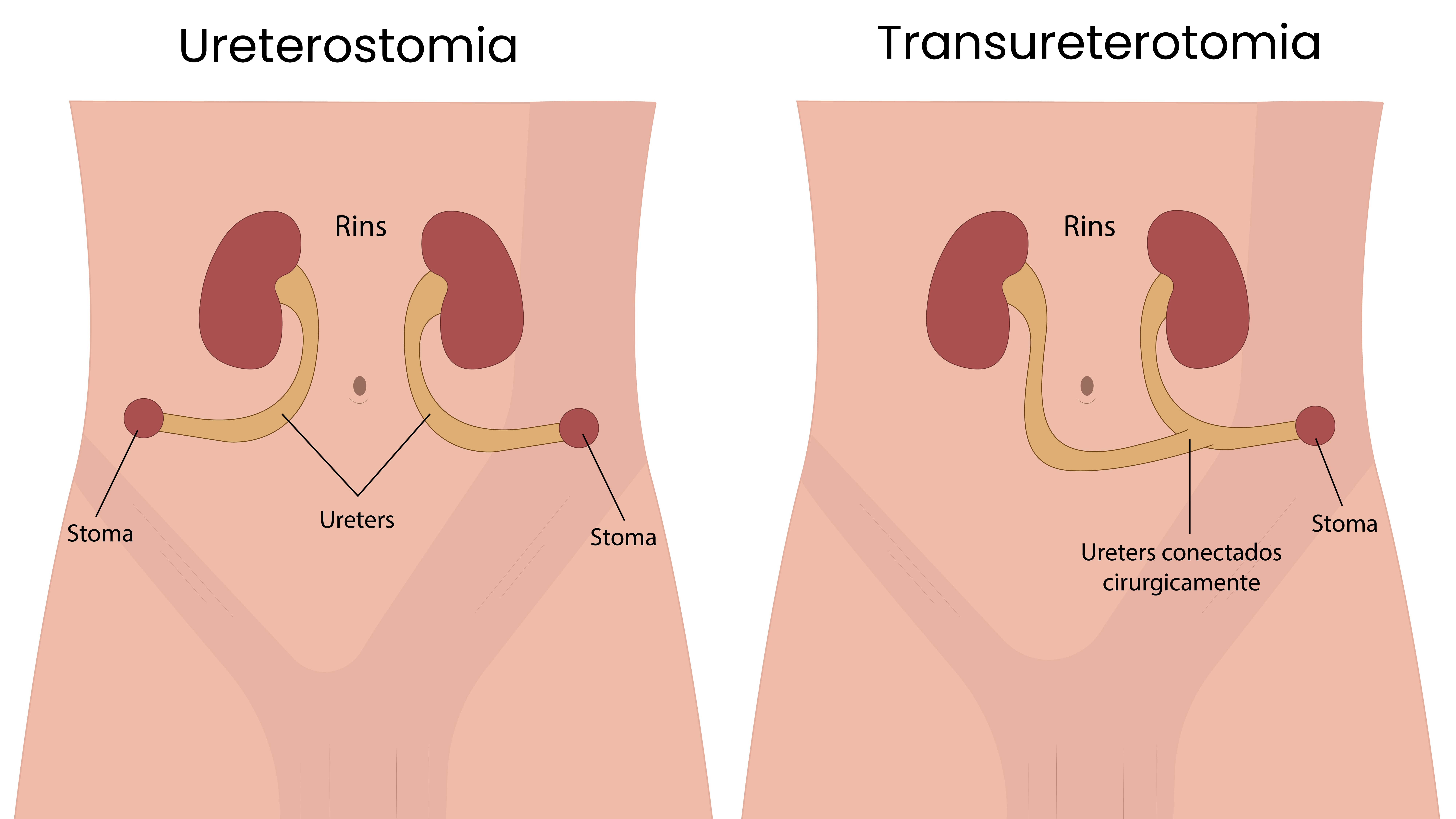 Ureterostomia cutânea