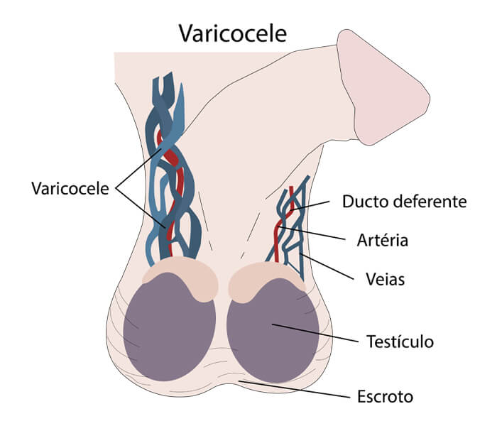 varicocele direita em maior aumento